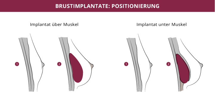 Grafik Lage Brustimplantate, Dr. Fitz, Klinikum Karlshöhe Breast, Stuttgart 
