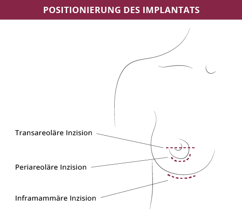 Grafik Brustimplantate Zugangswege, Dr. Fitz, Klinikum Karlshöhe Breast, Stuttgart 